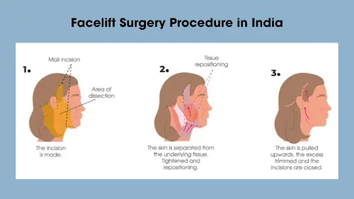 Facelift Surgery Procedure in India Facelift Surgery Procedure in India